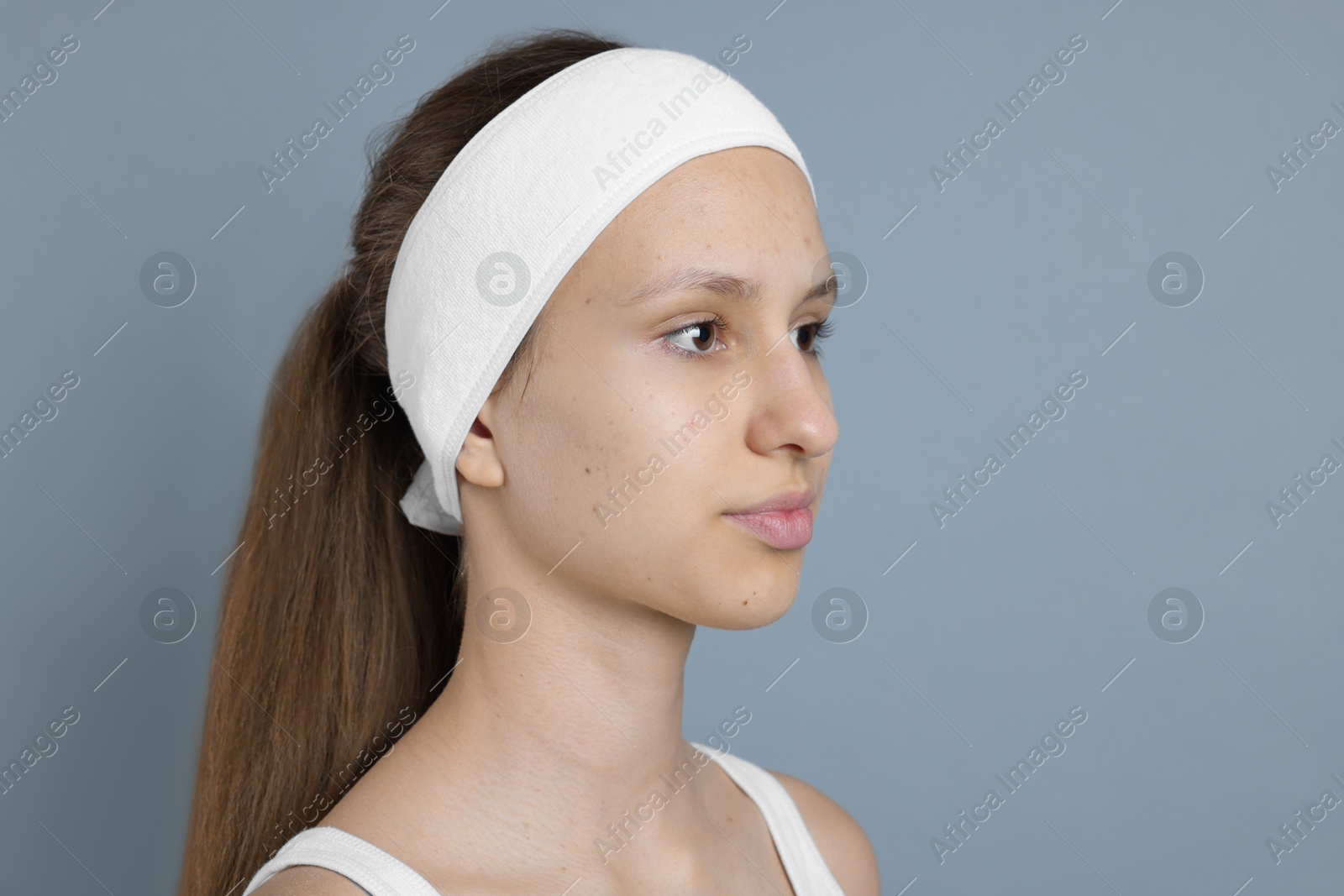 Photo of Teenage girl with acne problem on grey background. Space for text