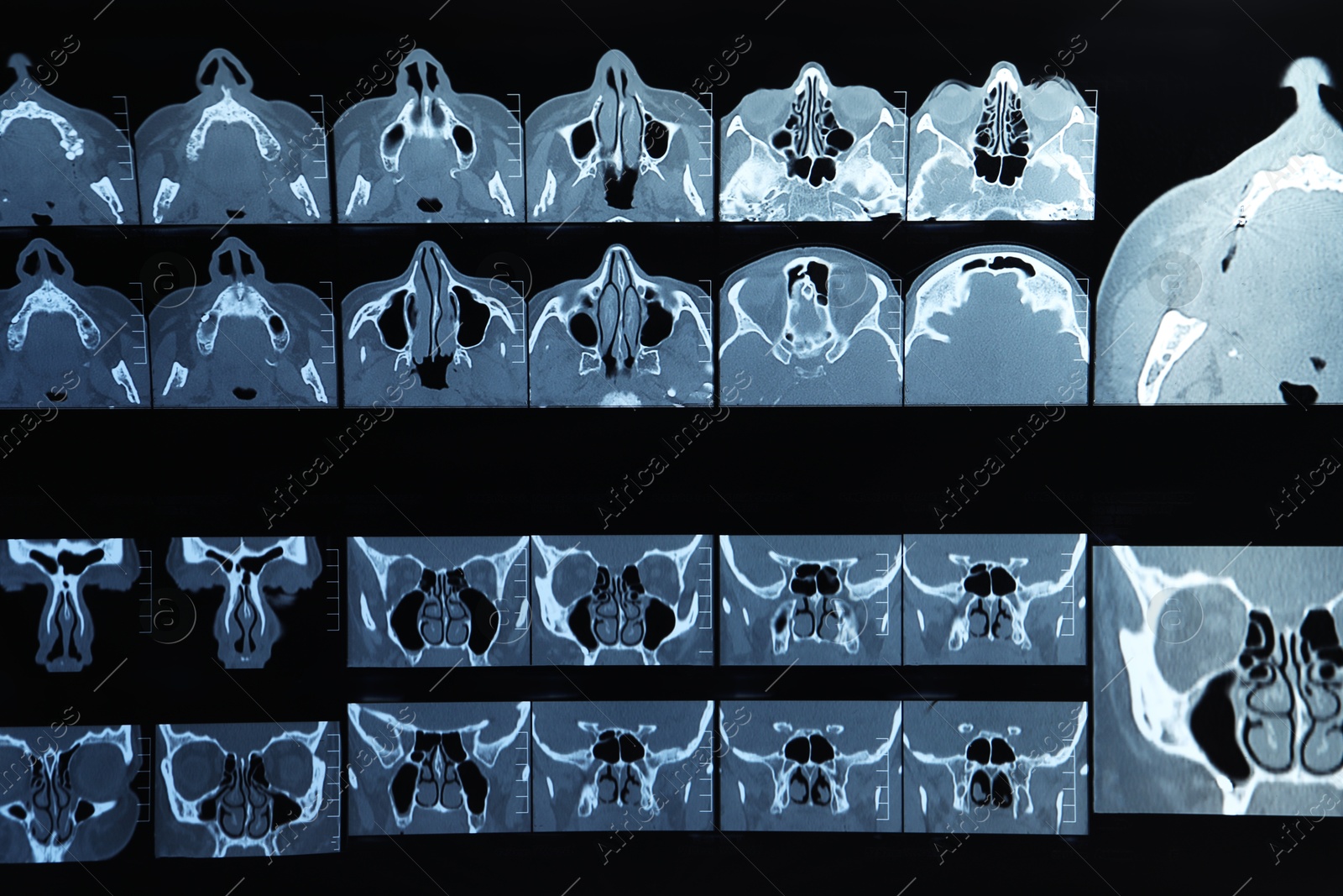 Photo of X-ray image of paranasal sinuses as background