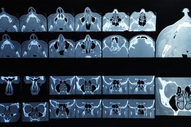 Photo of X-ray image of paranasal sinuses as background