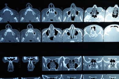 Photo of X-ray image of paranasal sinuses as background