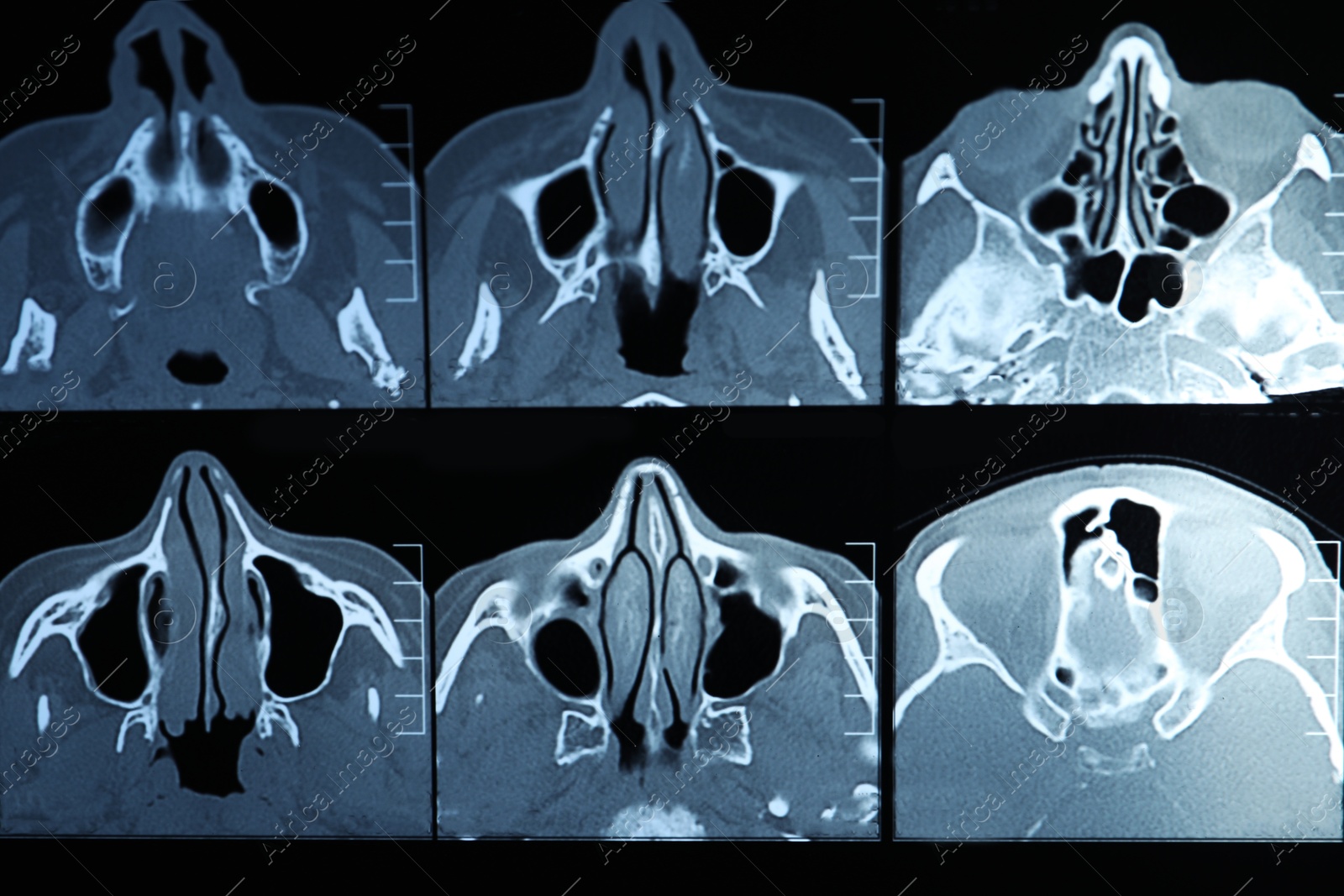 Photo of X-ray image of paranasal sinuses as background