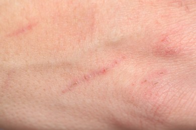 Photo of Texture of skin with scratches as background, closeup