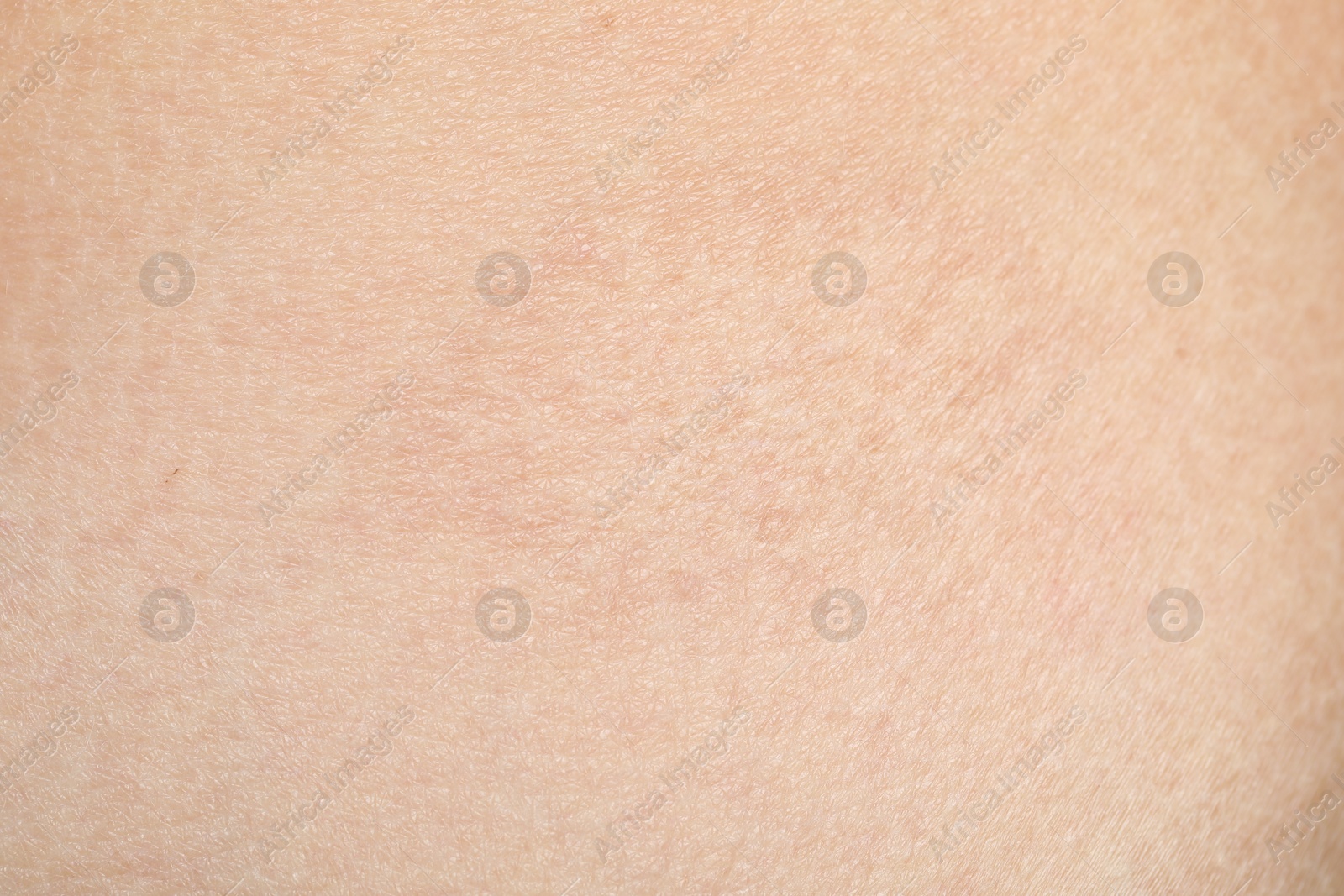 Photo of Texture of skin with scar as background, closeup