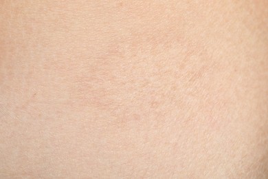 Photo of Texture of skin with scar as background, closeup