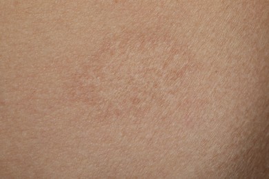 Photo of Texture of skin with scar as background, closeup