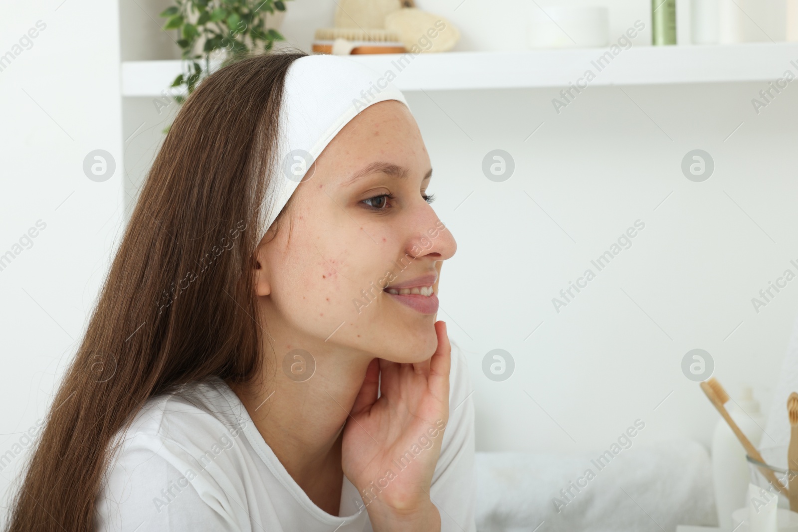 Photo of Teenage girl with acne problem at home. Space for text