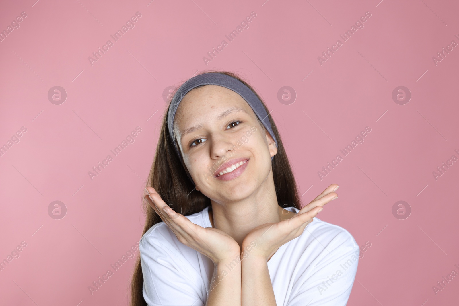 Photo of Teenage girl with acne problem on pink background