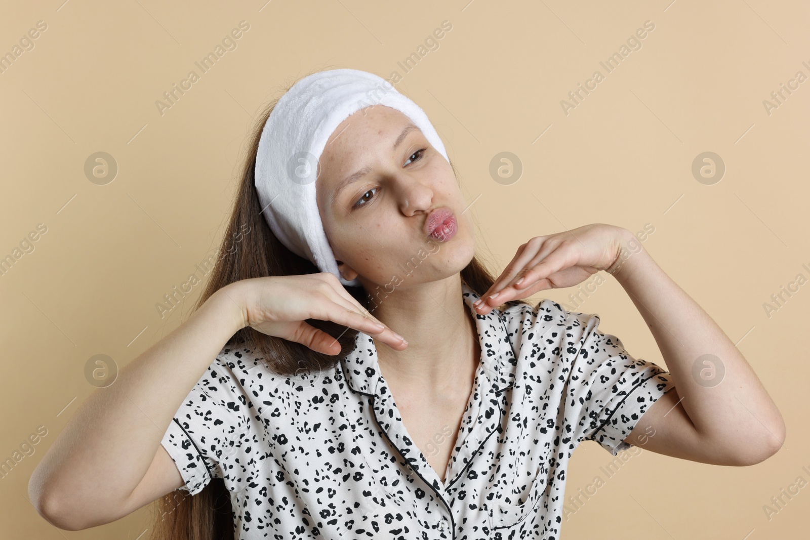 Photo of Teenage girl with acne problem on beige background