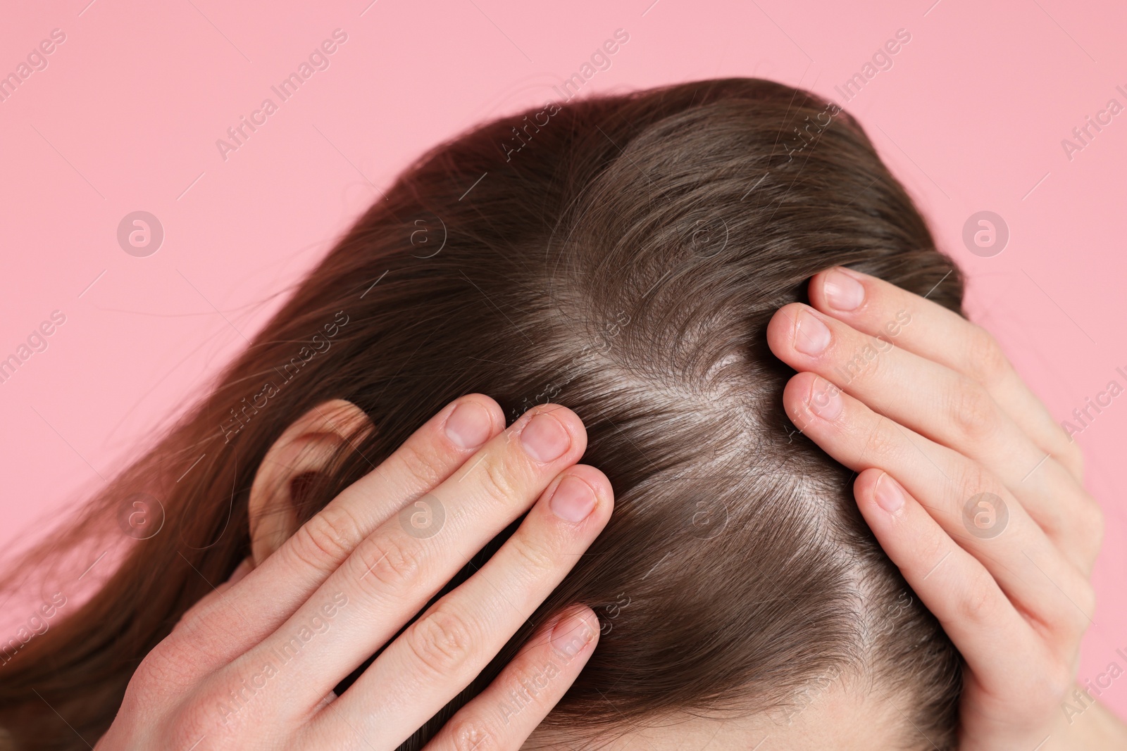 Photo of Girl with hair loss problem on pink background, closeup