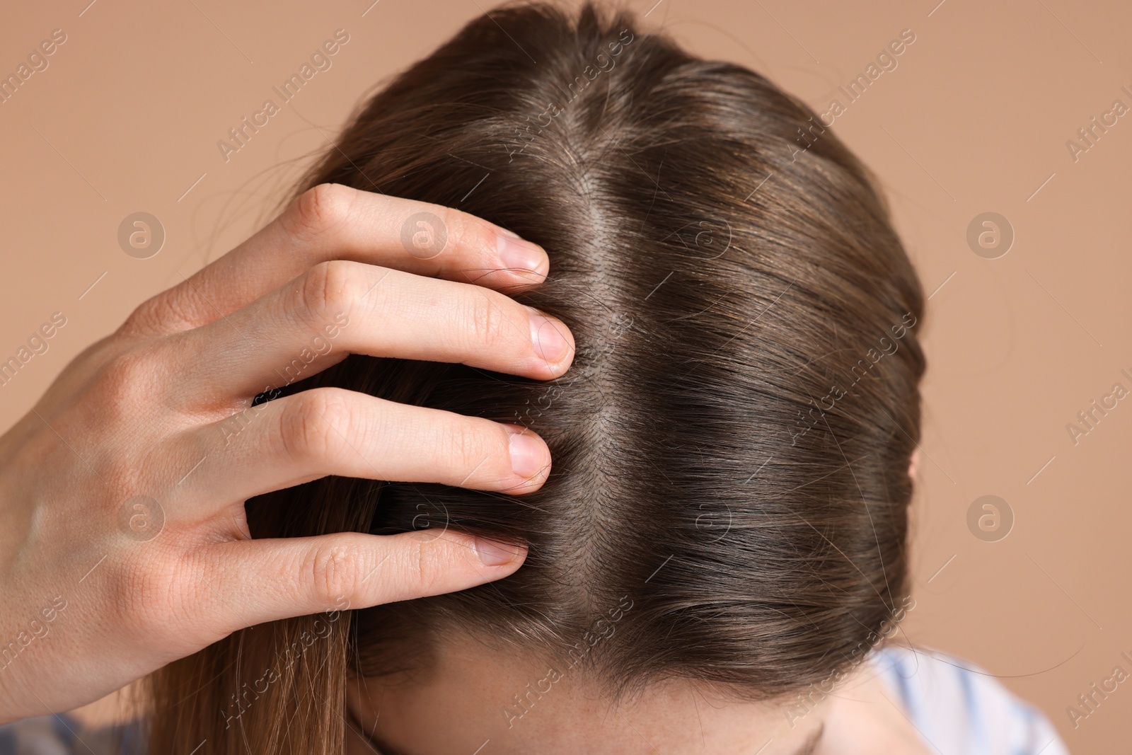 Photo of Girl with hair loss problem on dark beige background, closeup