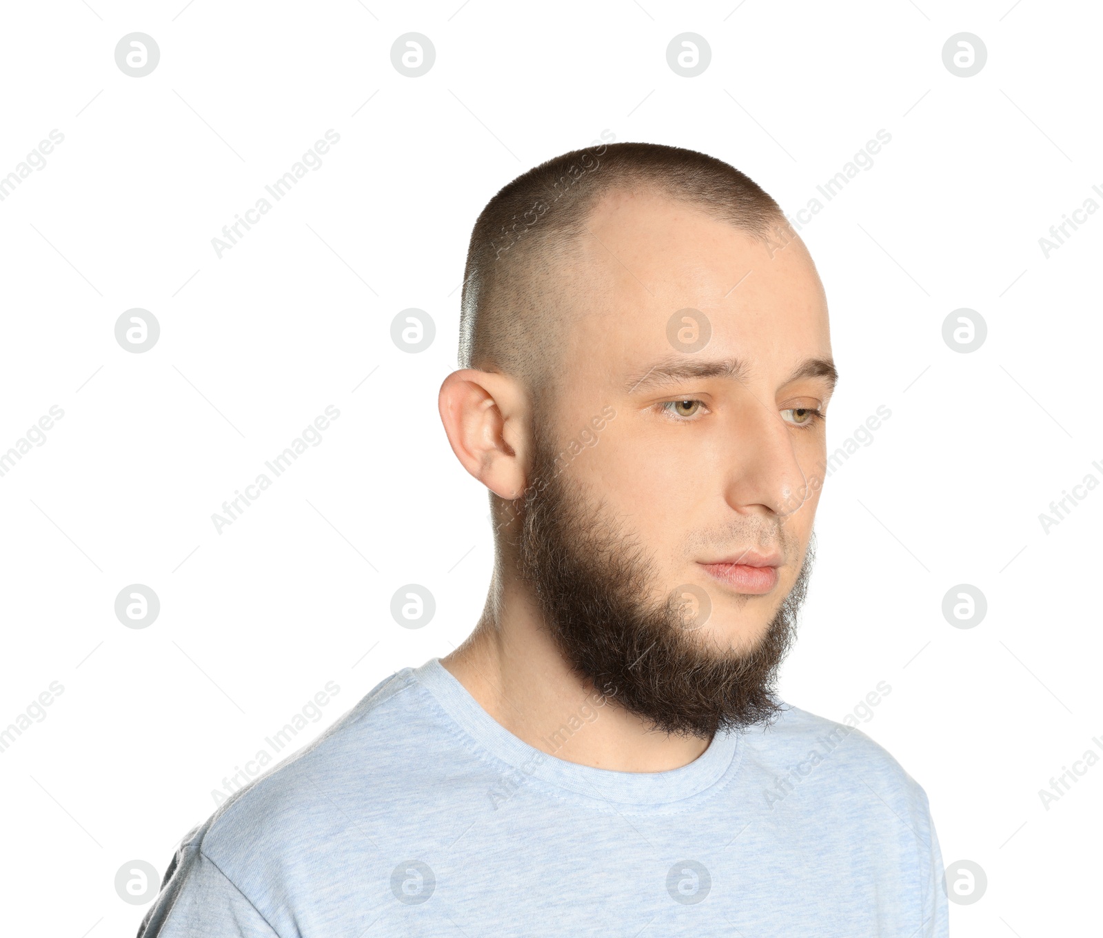 Baldness problem. Man with receding hairline on white background Photo of Baldness problem. Man with receding hairline on white background