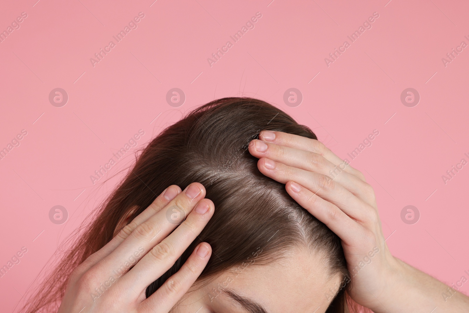 Photo of Girl with hair loss problem on pink background, closeup