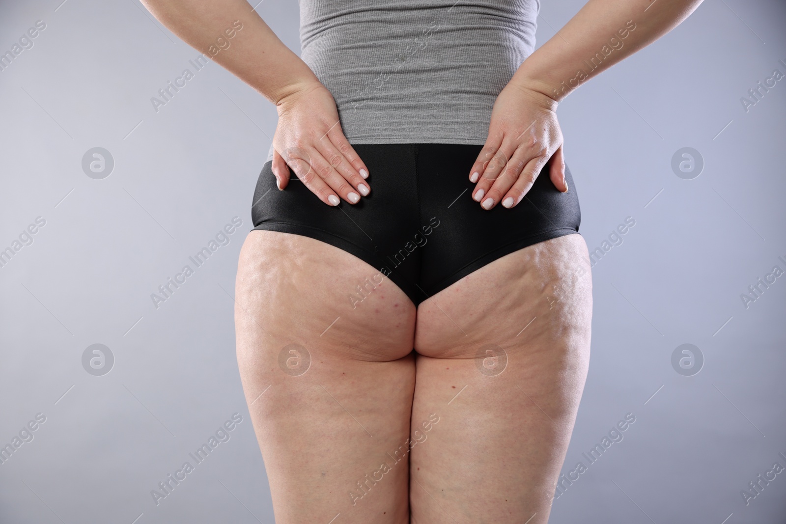 Photo of Woman with cellulite on light grey background, closeup