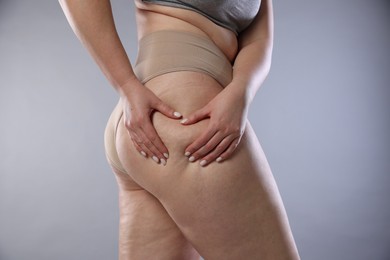 Photo of Woman with cellulite on light grey background, closeup