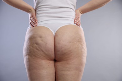 Photo of Woman with cellulite on light grey background, closeup