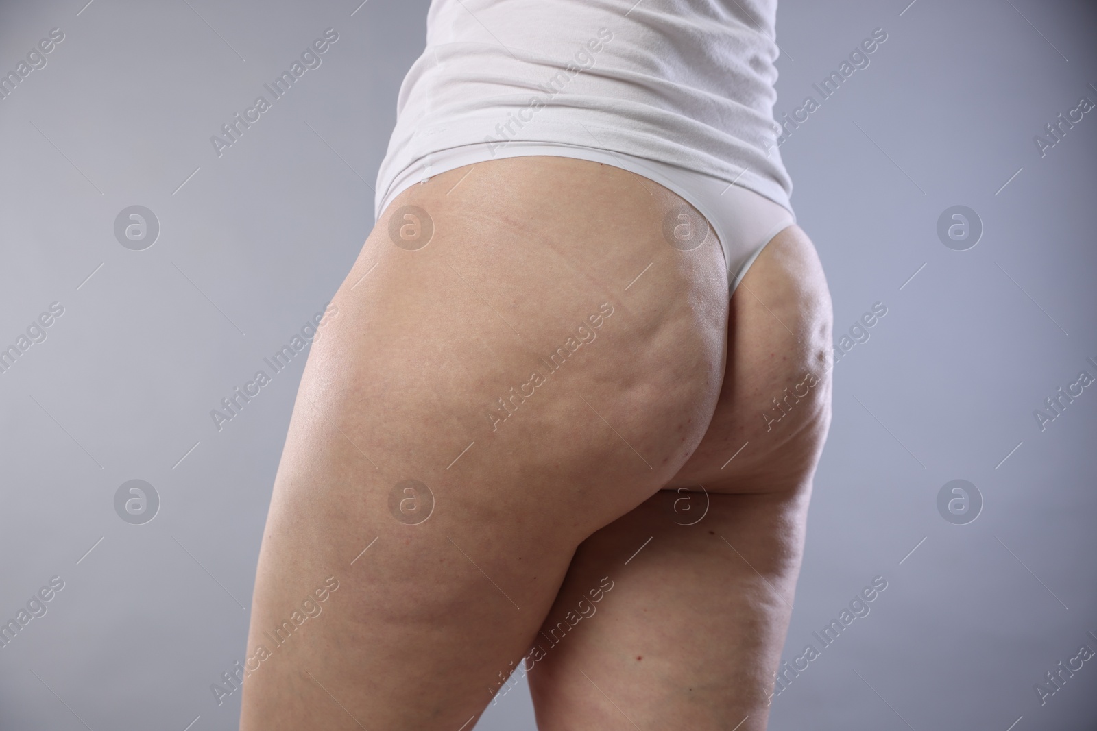 Photo of Woman with cellulite on light grey background, closeup