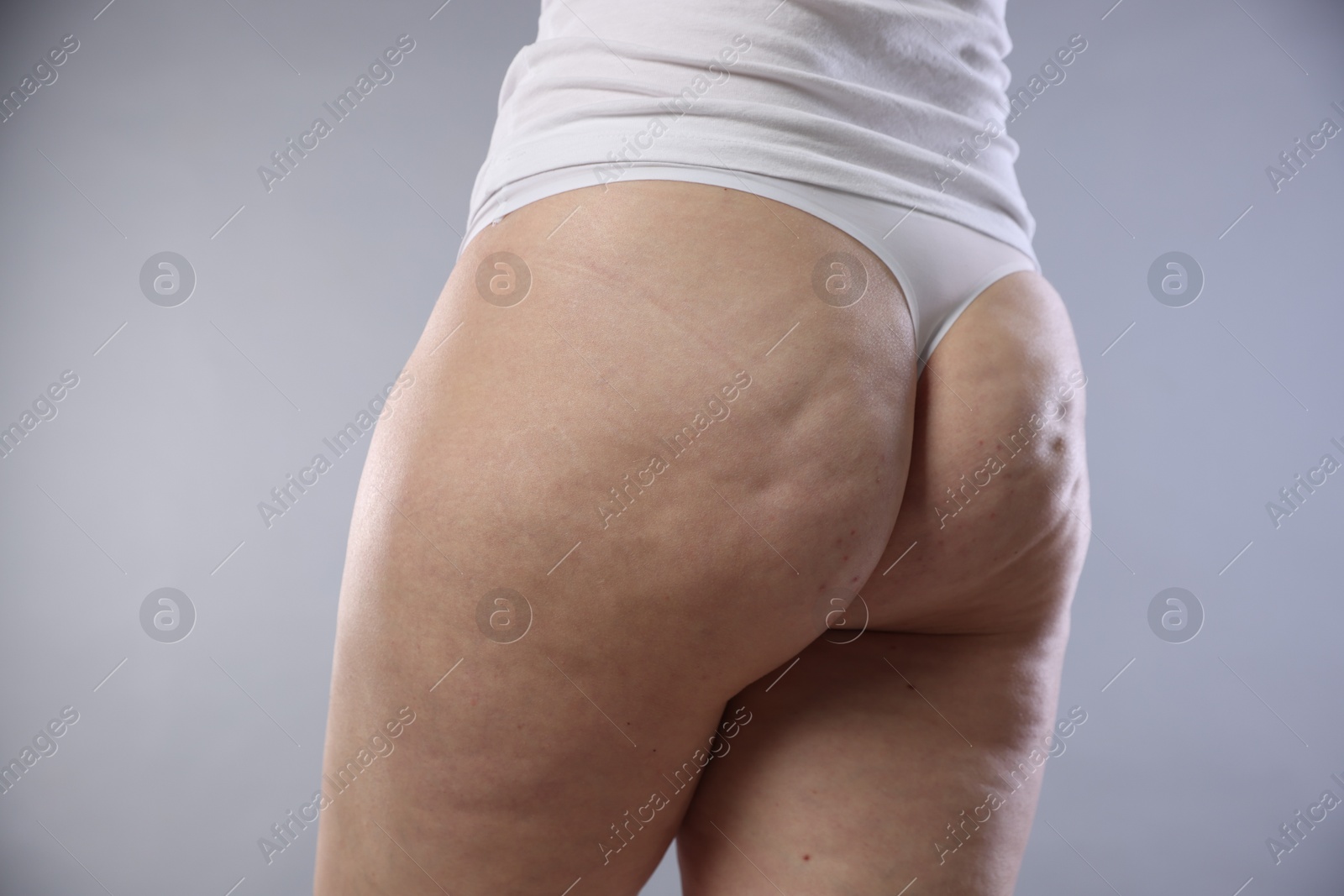 Photo of Woman with cellulite on light grey background, closeup