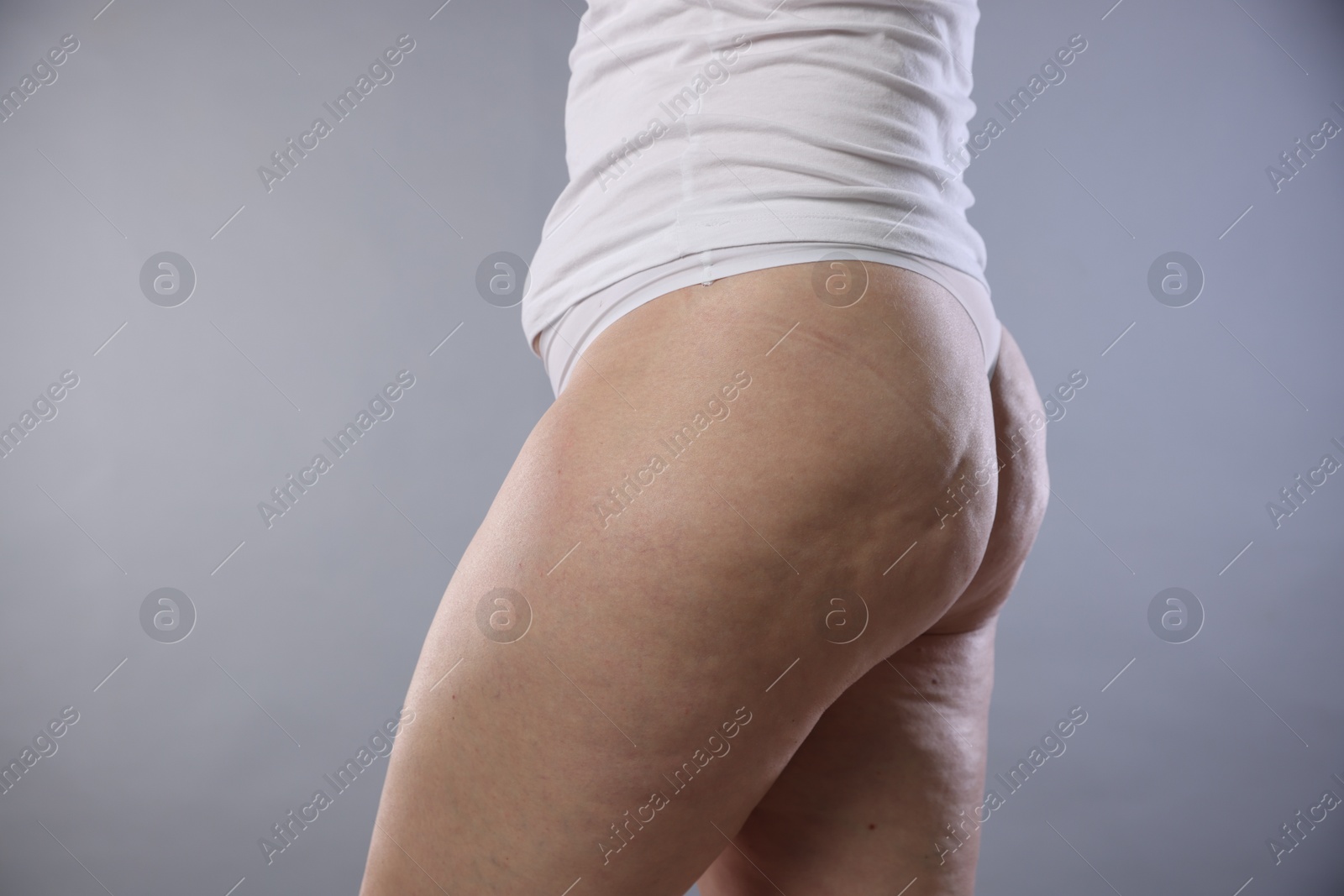 Photo of Woman with cellulite on light grey background, closeup