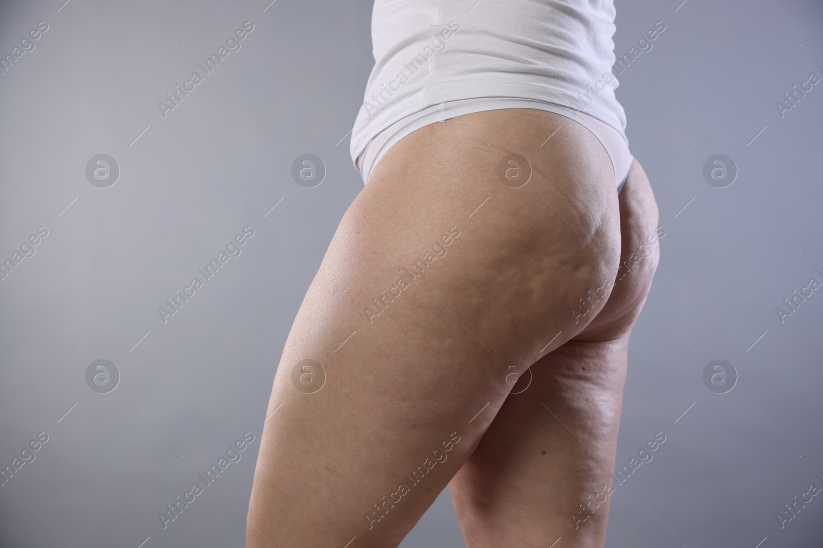 Photo of Woman with cellulite on light grey background, closeup