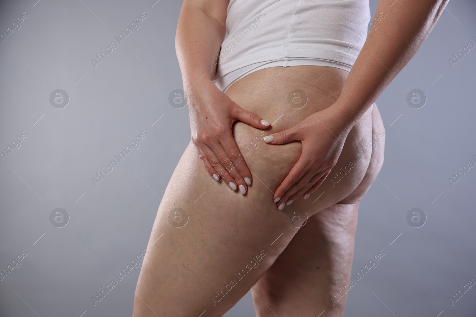 Photo of Woman with cellulite on light grey background, closeup