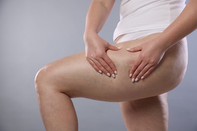 Photo of Woman with cellulite on light grey background, closeup