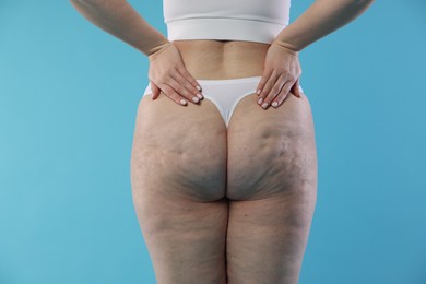 Photo of Woman with cellulite on light blue background, closeup