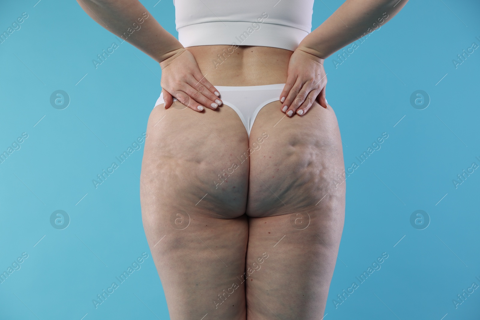 Photo of Woman with cellulite on light blue background, closeup