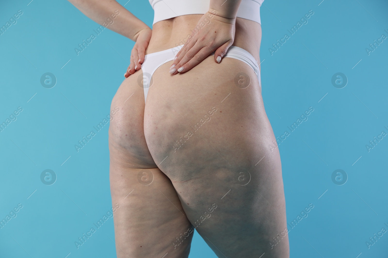 Photo of Woman with cellulite on light blue background, closeup