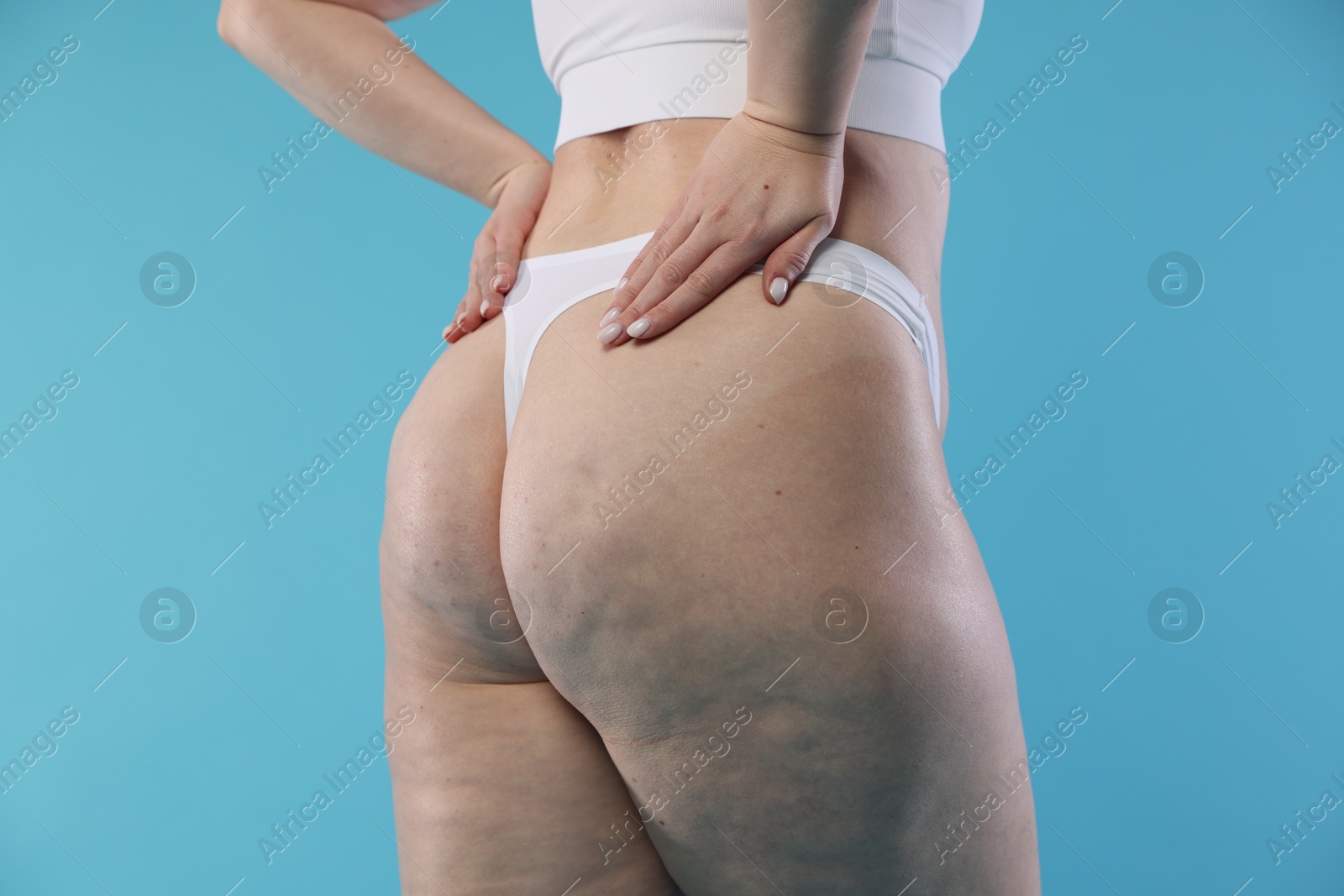 Photo of Woman with cellulite on light blue background, closeup