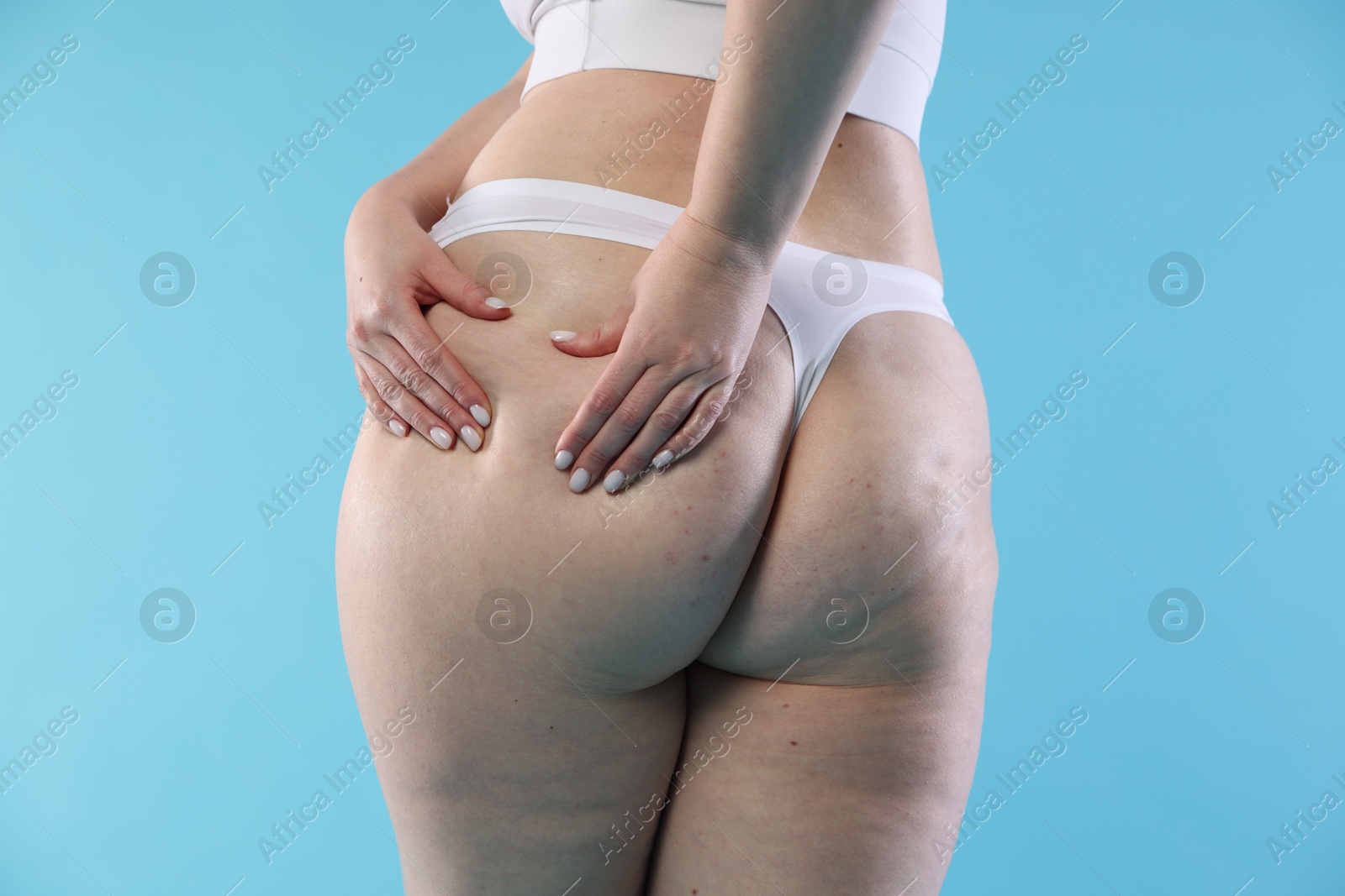 Photo of Woman with cellulite on light blue background, closeup