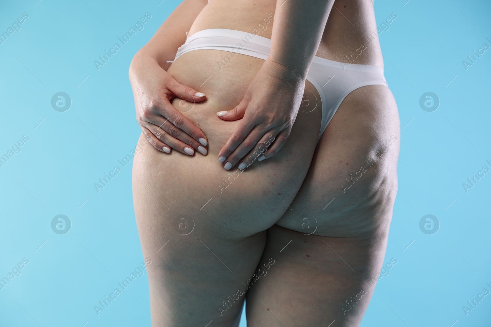 Photo of Woman with cellulite on light blue background, closeup