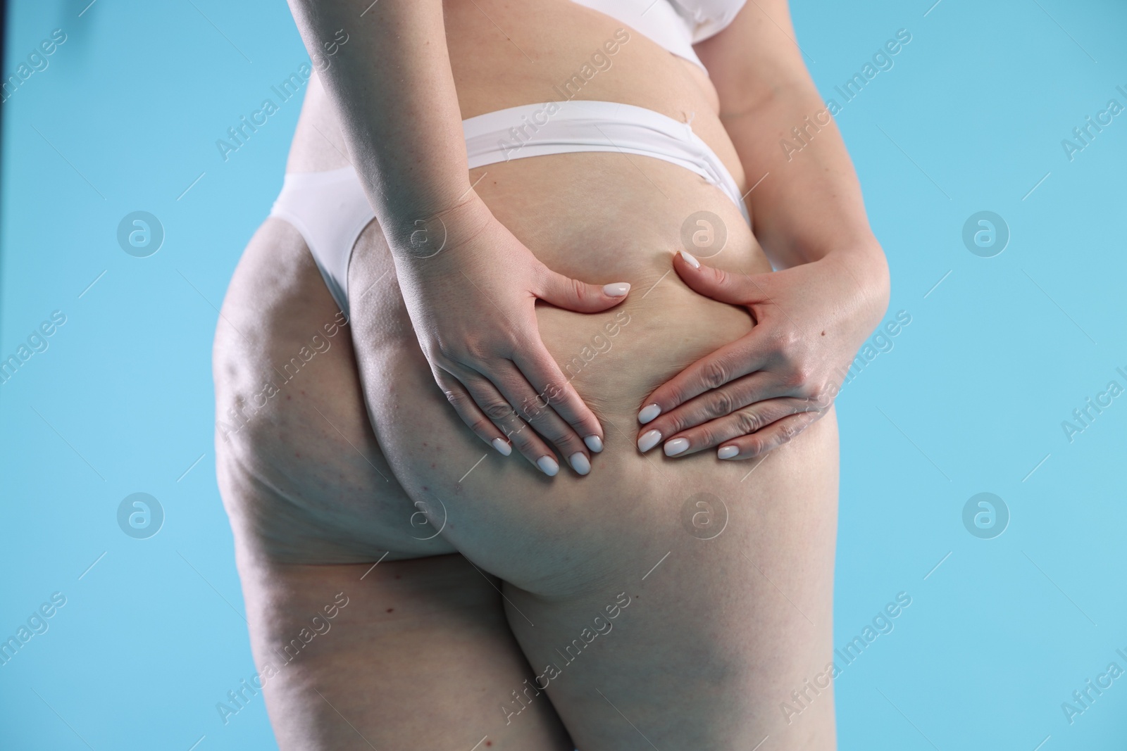 Photo of Woman with cellulite on light blue background, closeup