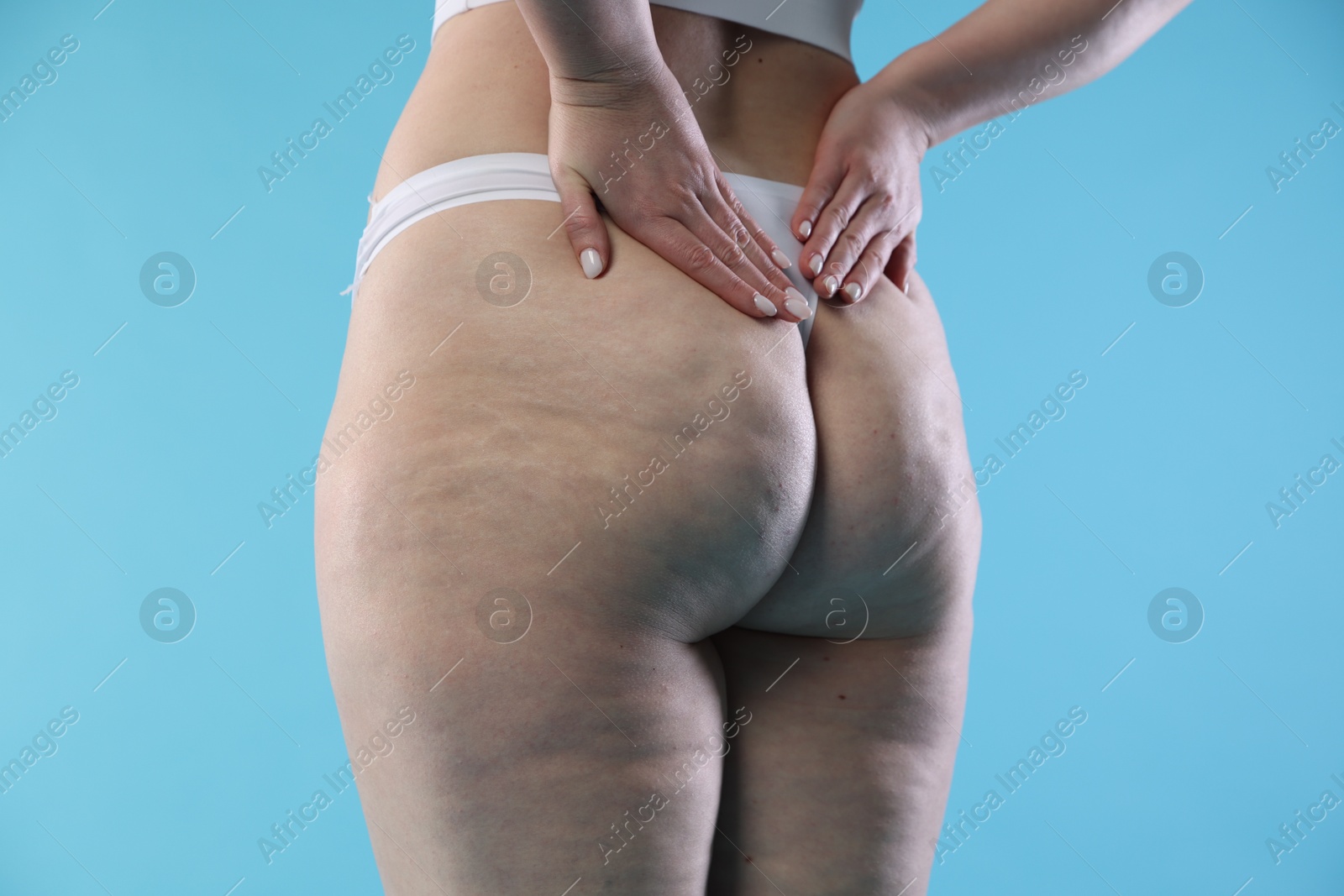 Photo of Woman with cellulite on light blue background, closeup