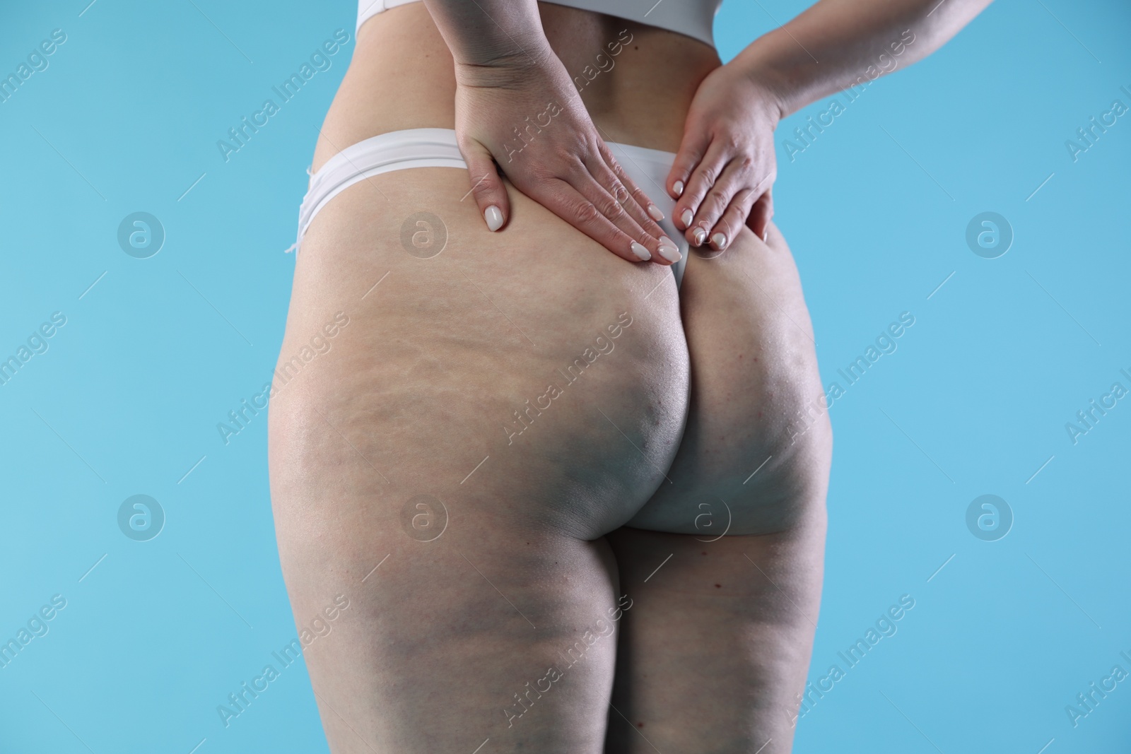 Photo of Woman with cellulite on light blue background, closeup