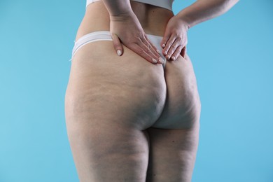 Photo of Woman with cellulite on light blue background, closeup