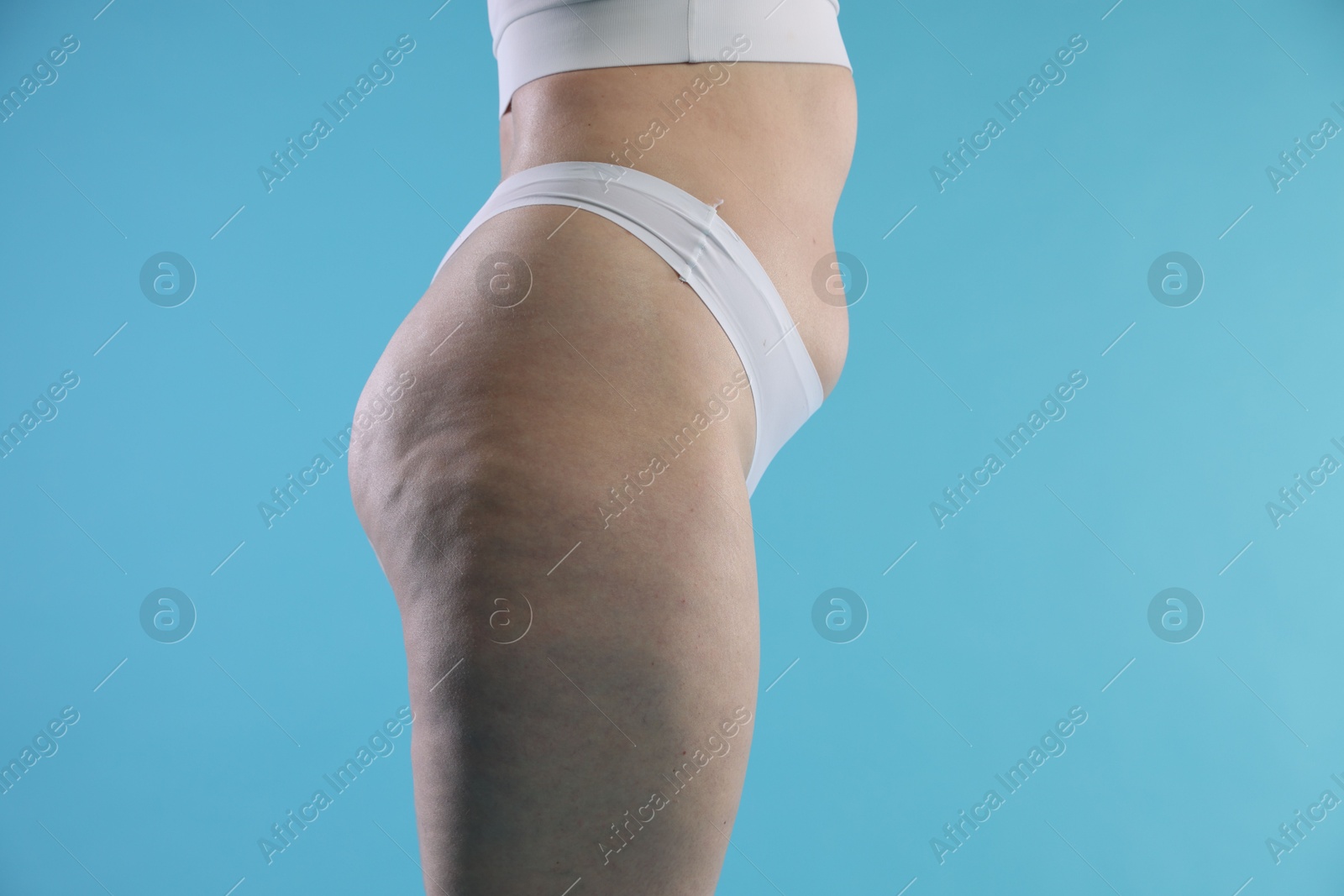 Photo of Woman with cellulite on light blue background, closeup