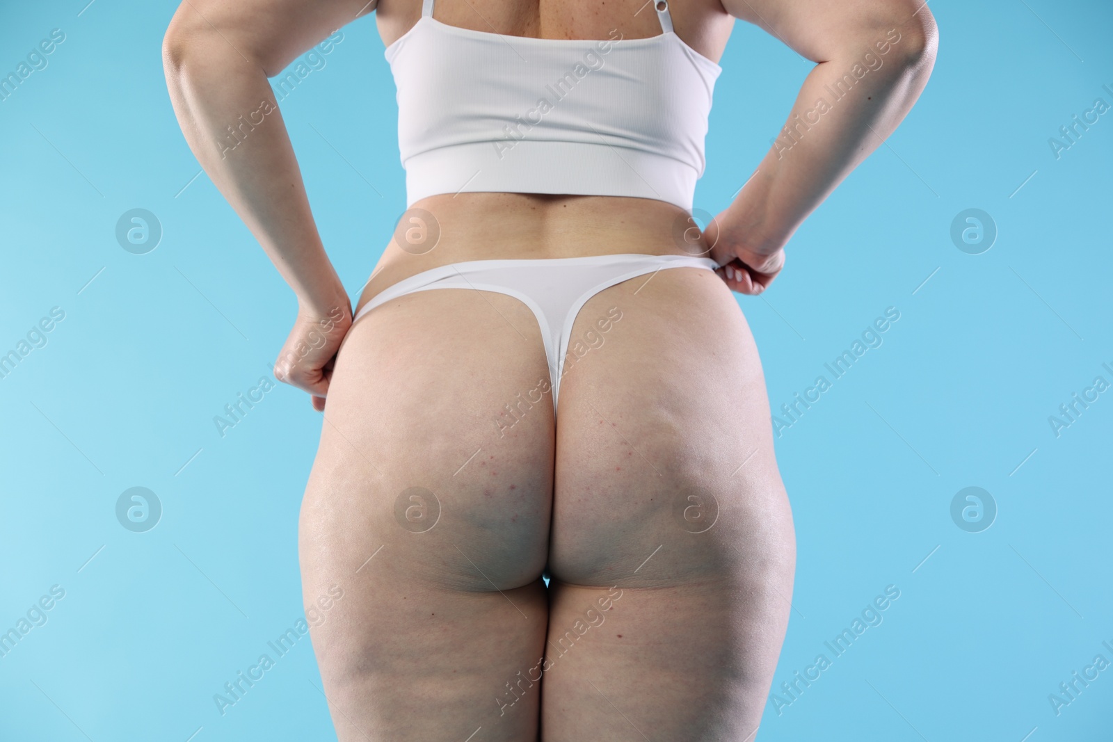 Photo of Woman with cellulite on light blue background, closeup