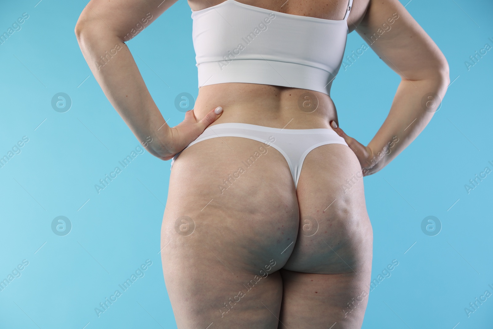 Photo of Woman with cellulite on light blue background, closeup