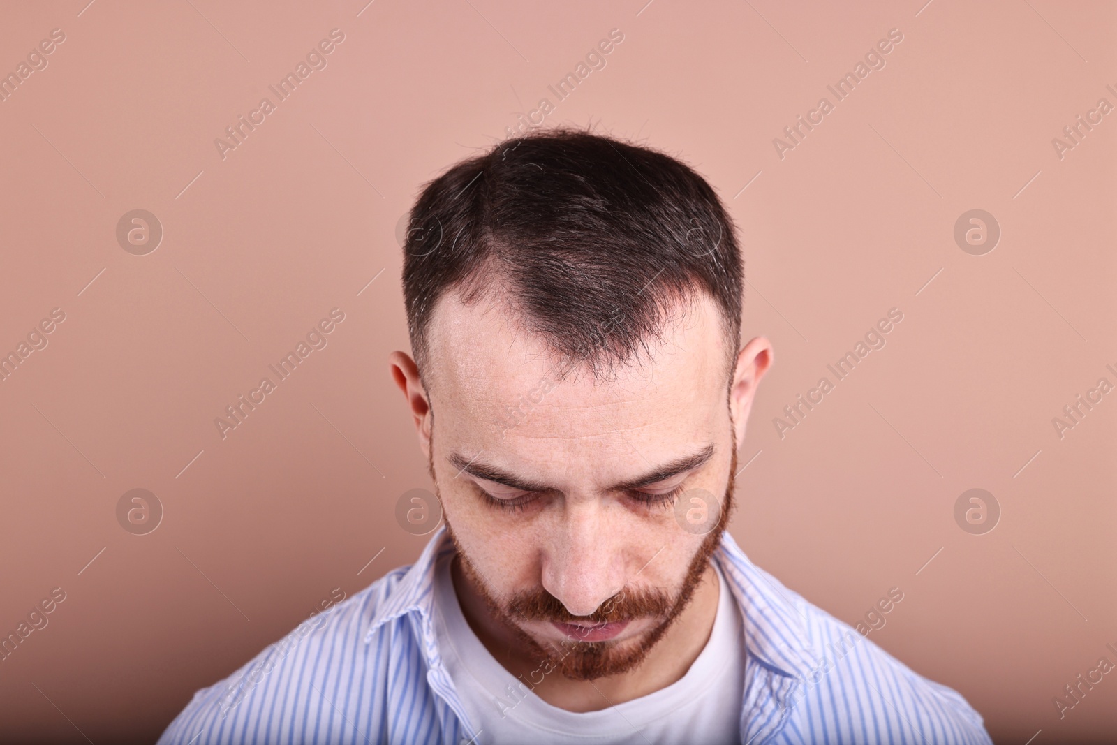 Photo of Baldness problem. Man with receding hairline on dark beige background