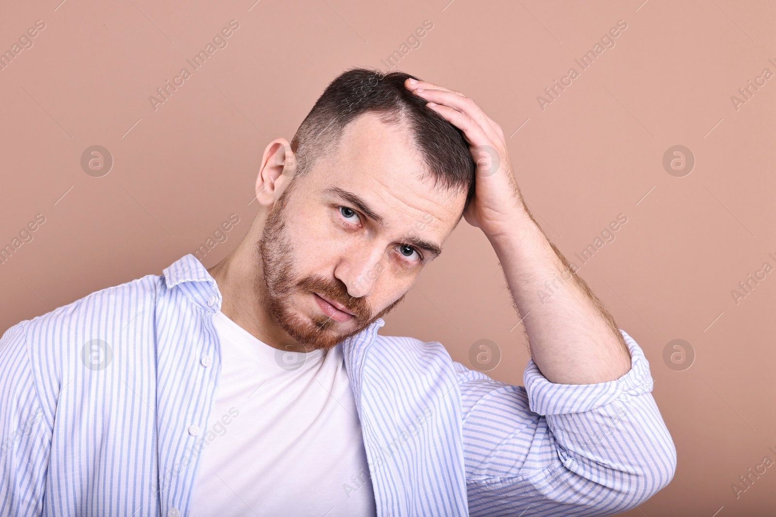 Photo of Baldness problem. Man with receding hairline on dark beige background