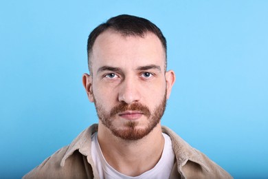 Baldness problem. Man with receding hairline on light blue background