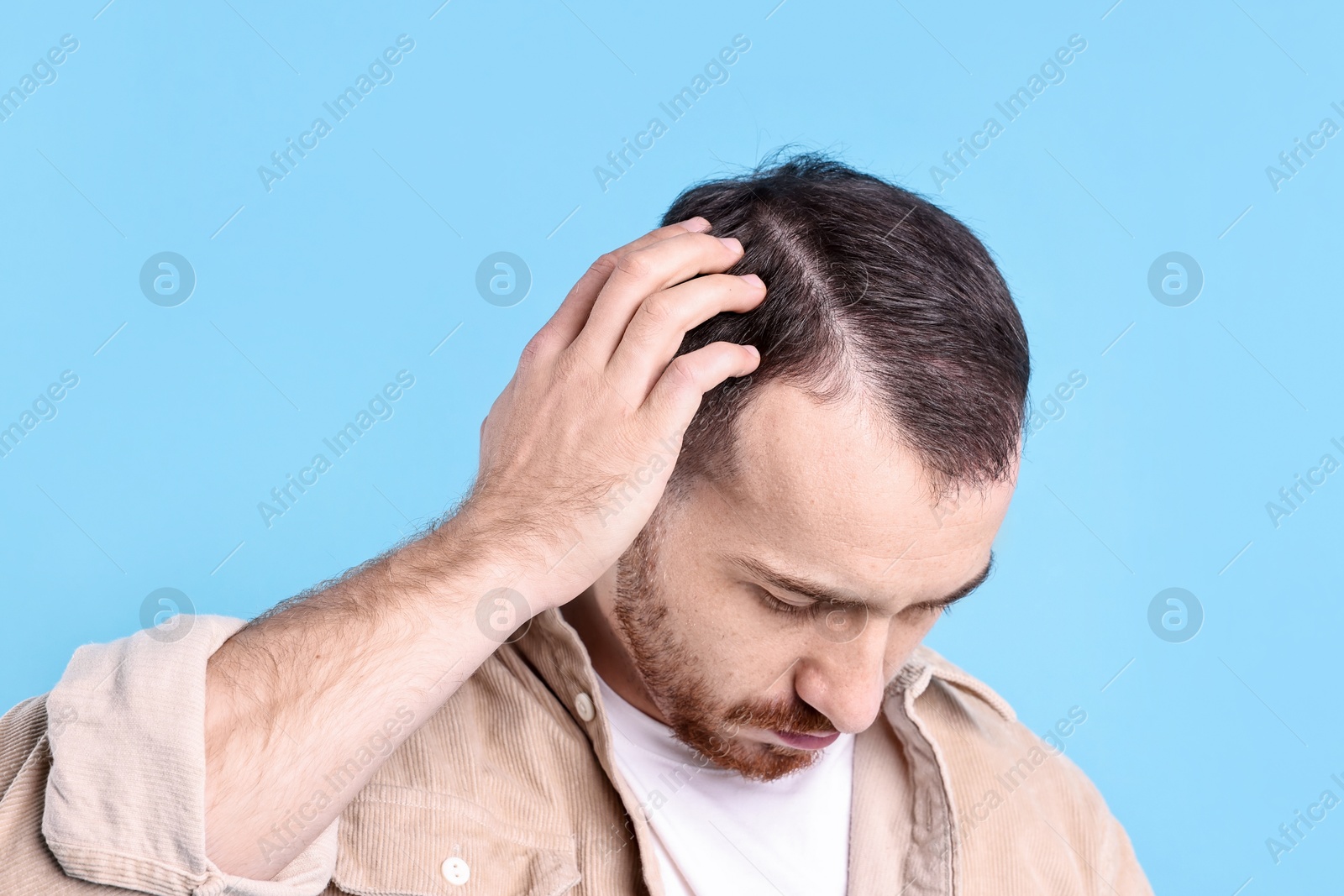 Photo of Baldness problem. Man with receding hairline on light blue background