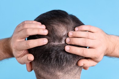 Baldness problem. Man with bald spot on light blue background, back view