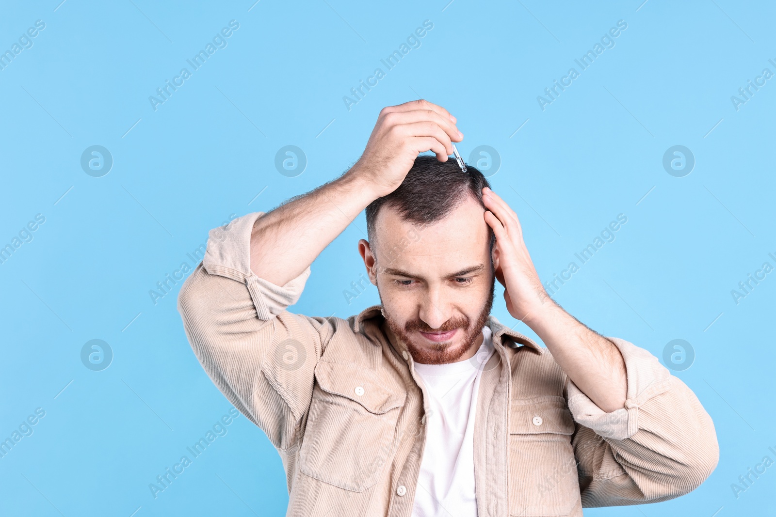 Photo of Baldness problem. Man applying serum onto hairline on light blue background