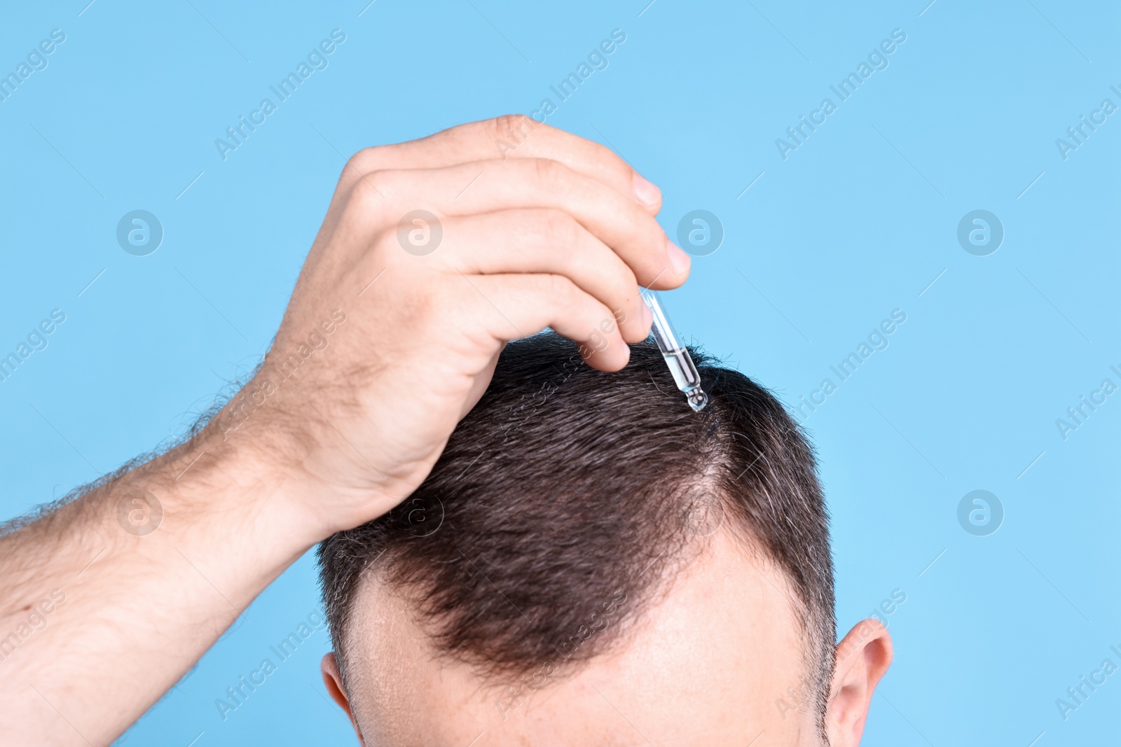 Photo of Baldness problem. Man applying serum onto hairline on light blue background, closeup