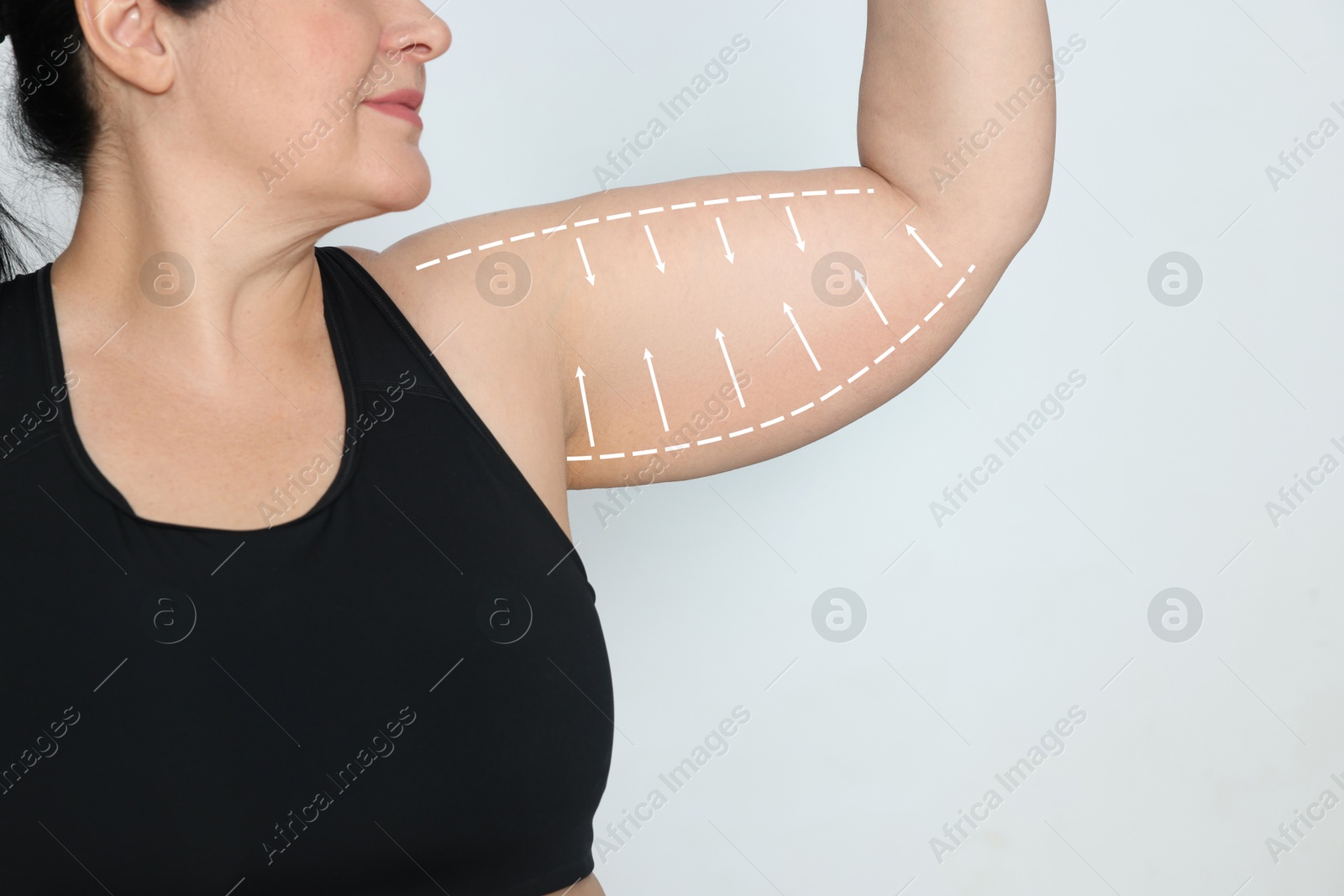 Image of Plastic surgery. Woman showing arm with excessive fat on white background, closeup. Figure correction arrows and lines on skin