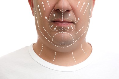 Image of Plastic surgery. Mature man with double chin on white background, closeup. Correction arrows and lines on skin