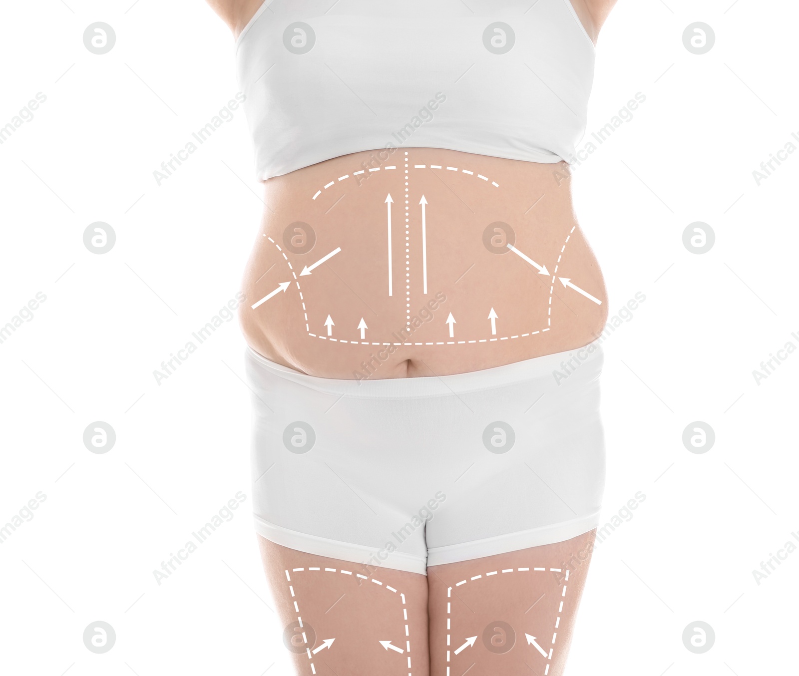 Image of Plastic surgery. Woman with excessive fat on white background, closeup. Figure correction arrows and lines on skin