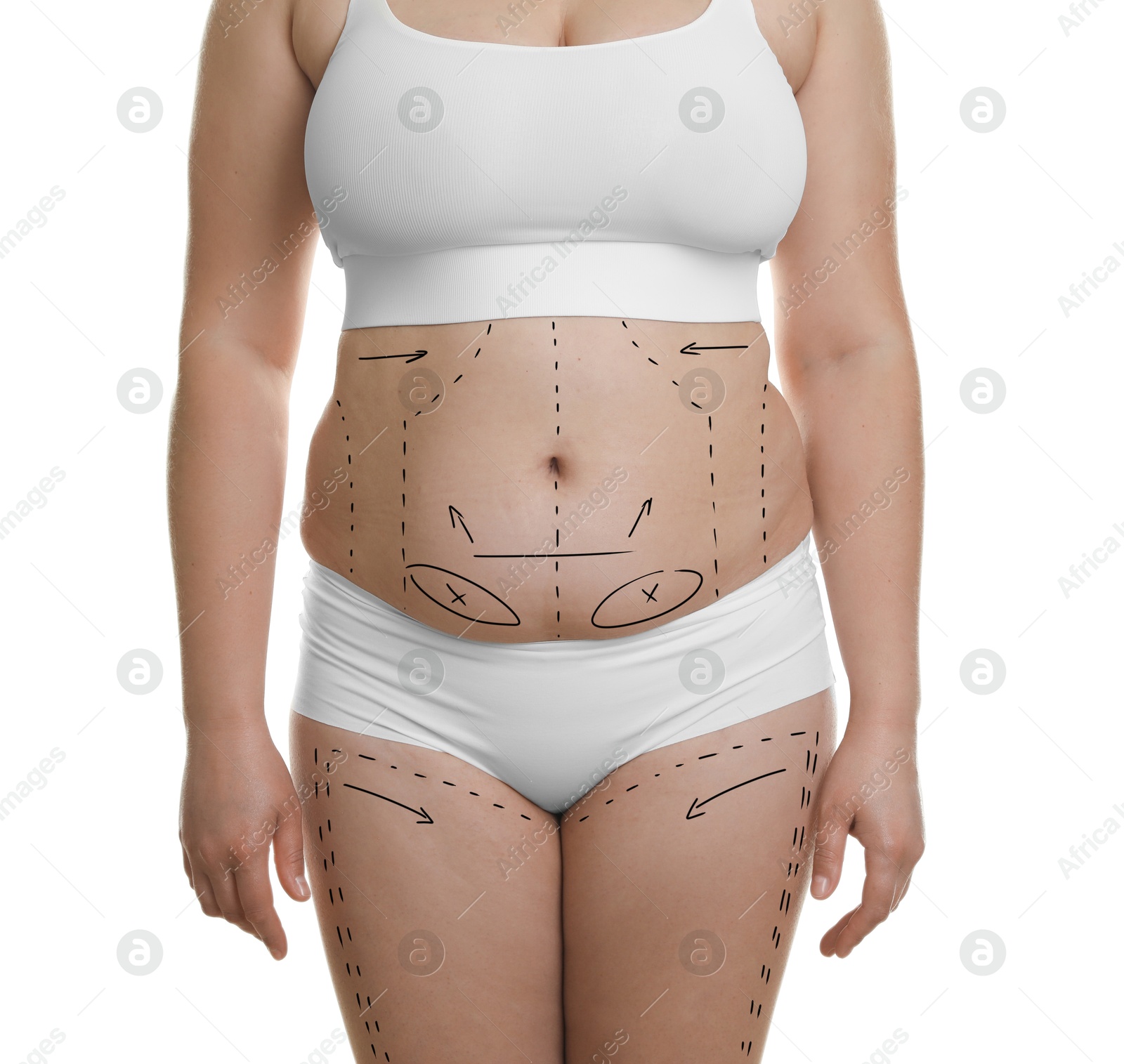 Image of Plastic surgery. Woman with excessive fat on white background, closeup. Figure correction arrows and lines on skin