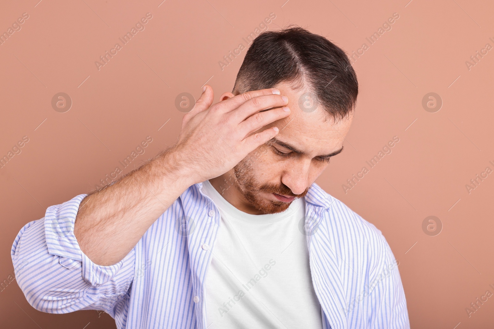 Photo of Baldness problem. Man with receding hairline on dark beige background